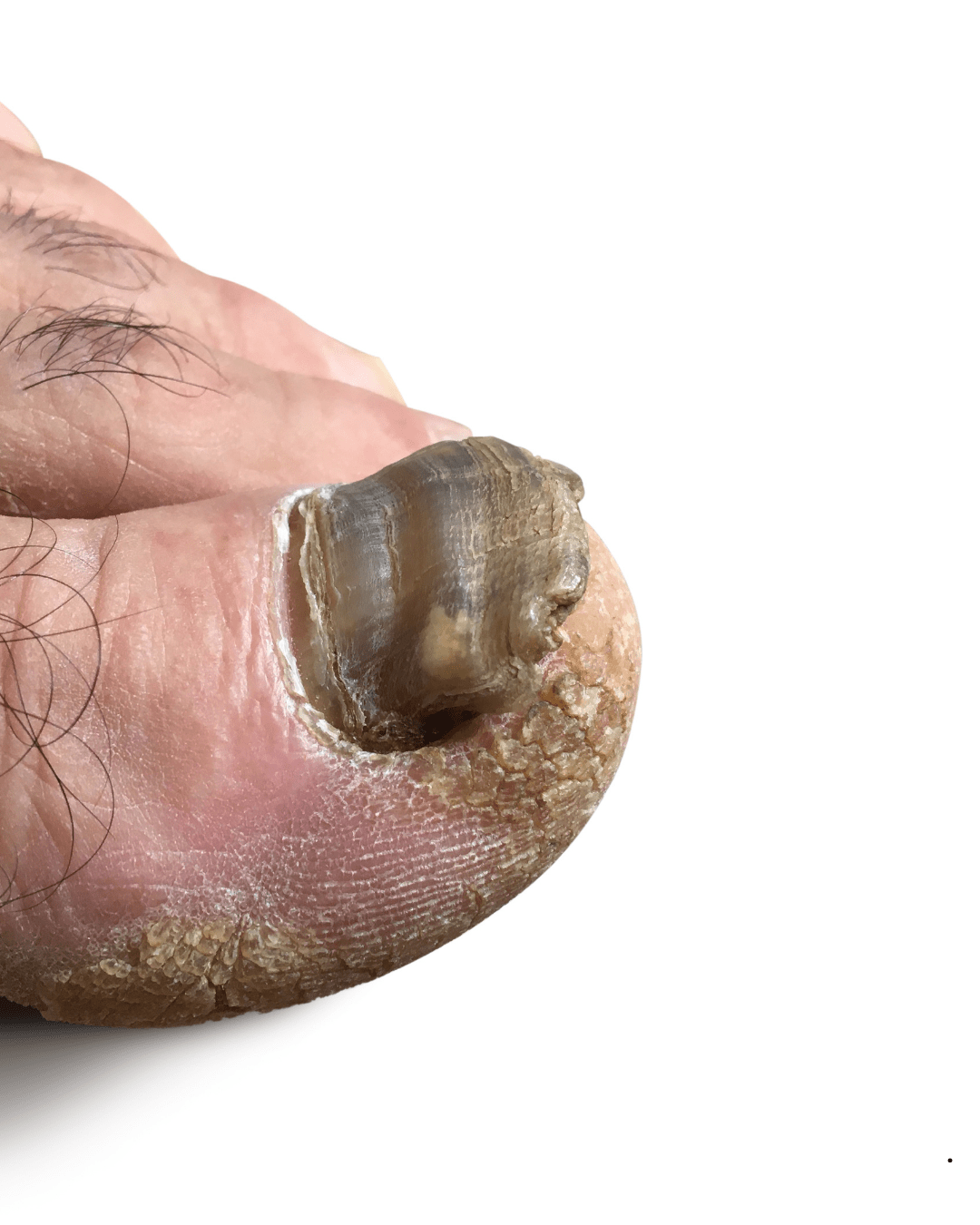 FUNAL NAIL LASER TREATMENT WOLVERHAMPTON