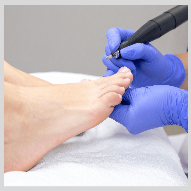 FUNGAL NAIL LASER WOLVERHAMPTON FEET (2) FOOT CLINIC AND PODIATRIST WOLVERHAMPTON